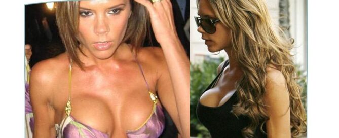 seno Victoria Beckam mastoplastica Catania Youplast