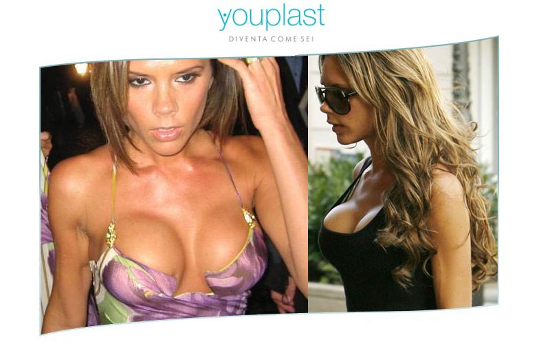 seno Victoria Beckam mastoplastica Catania Youplast